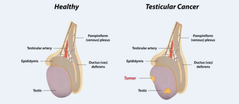 kidney stone disease 1